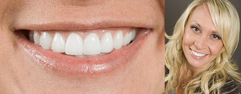 Teeth Whitening Palm Springs