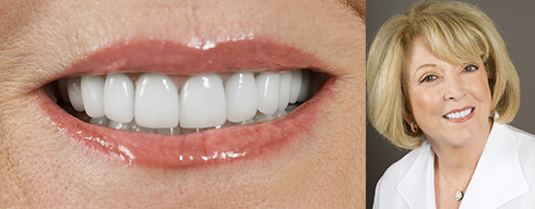 Teeth Whitening Palm Springs